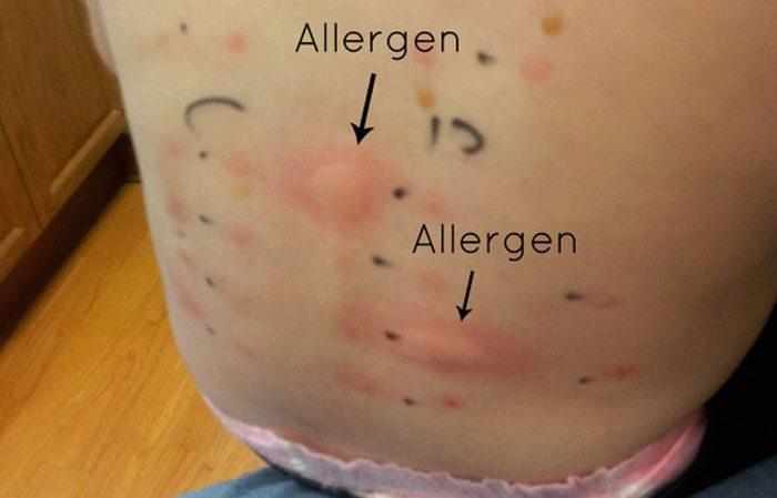 Положительные пробы на аллергены