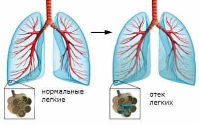 Отек легких