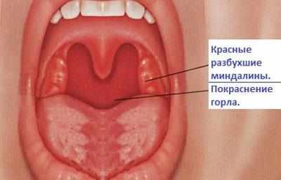 Вирусная ангина