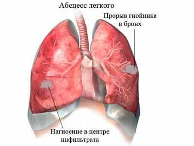Абсцесс легкого