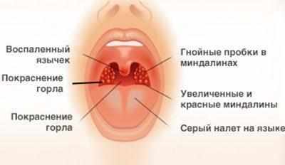 Признаки ангины