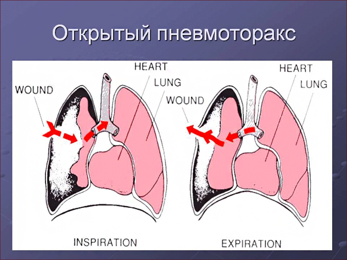 открытая форма пневмоторакса