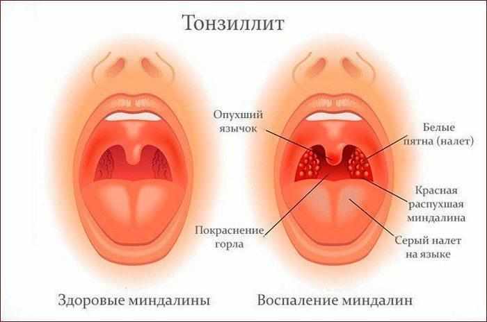 Хроническая ангина (тонзиллит) симптомы
