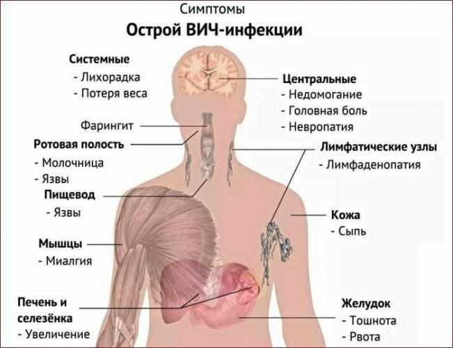 Симптомы вич-инфекции