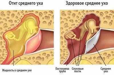 Средний отит