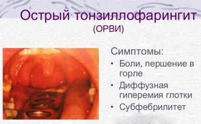Симптомы тонзиллофарингита