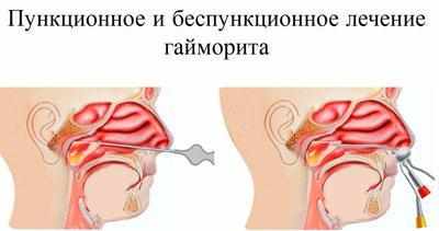 Виды промываний носа