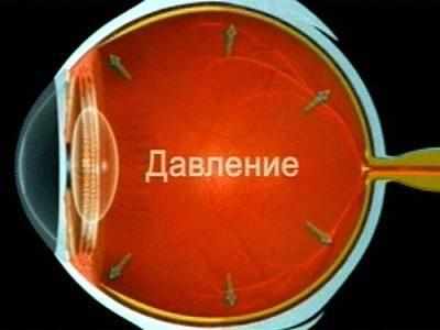 Повышение внутриглазного давления