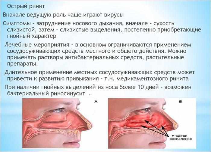 Симптомы гнойного ринита