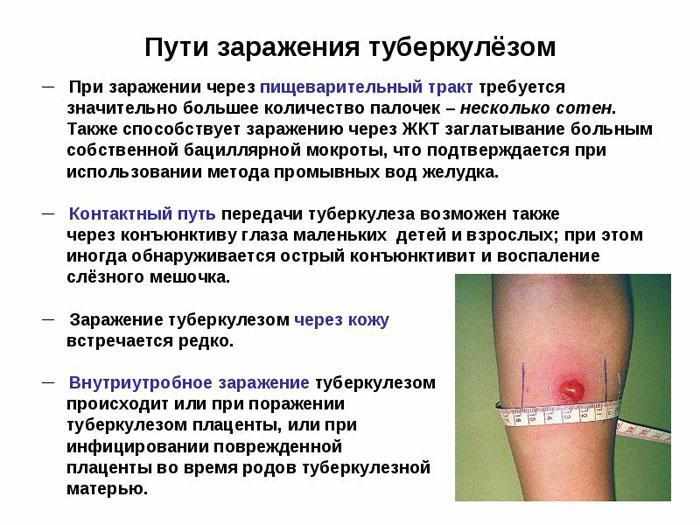 Пути заражения туберкулезом