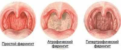 Виды фарингита