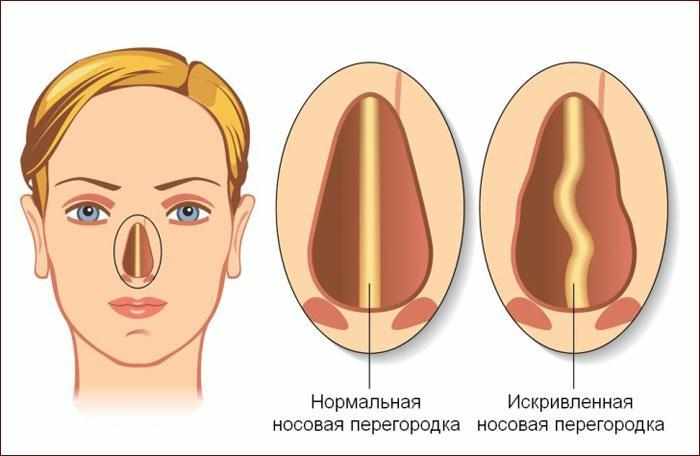 Искривление носовой перегородки