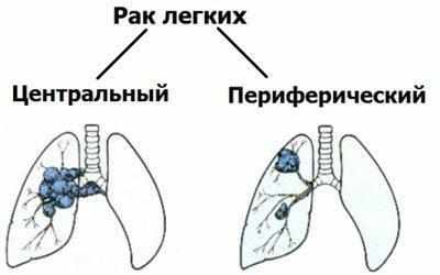Виды рака легкого