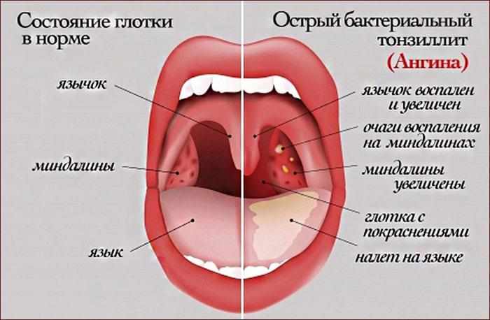 симптомы гнойной ангины