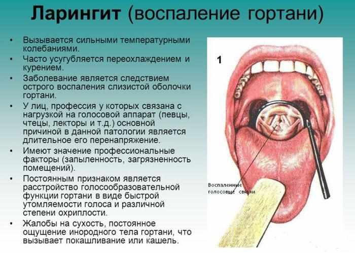 Симптомы ларингита