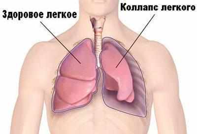 Пневмоторакс легкого