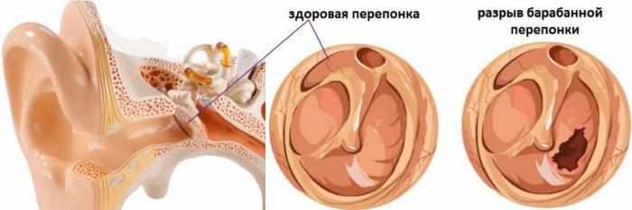 Перфорация