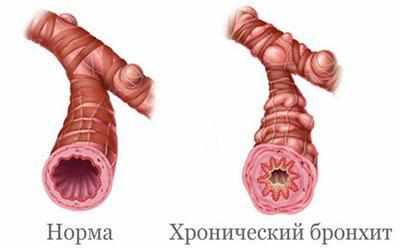 Бронхи при воспалении