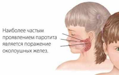 Проявление паротита