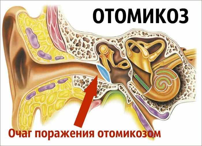 Расположение очага поражения Отомикозом.