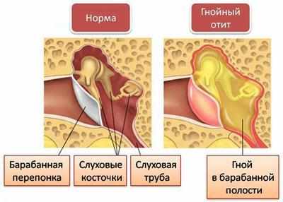 Проявление гнойного отита