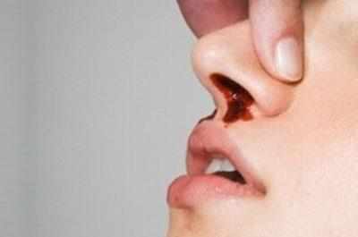 Кровотечение из носа