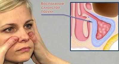 Воспаление при синусите