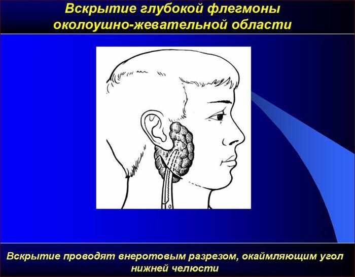Вскрытие глубокой флегмоны околоушной жевательной области
