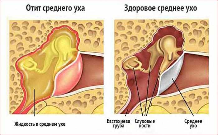 Симптомы отита