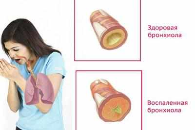 Воспаление при бронхите