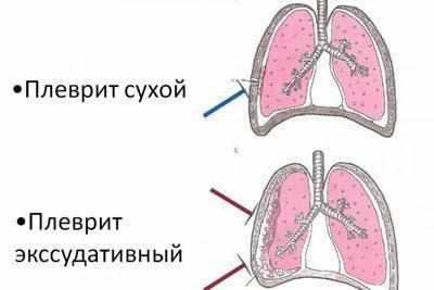 Виды плеврита