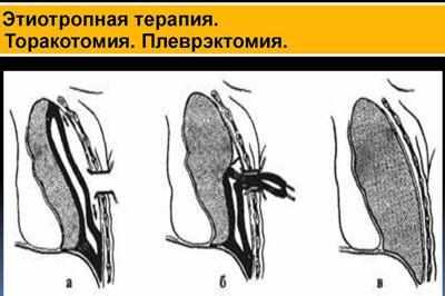 Операции при мезотелиоме