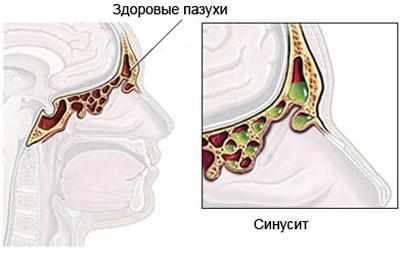 Проявление синусита