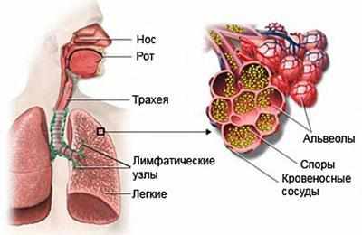 Аспергиллёз лёгких
