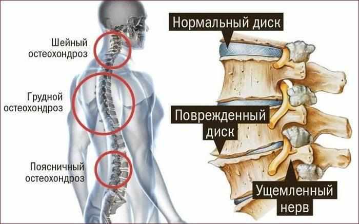 Остеохондроз шейного отдела позвоночника