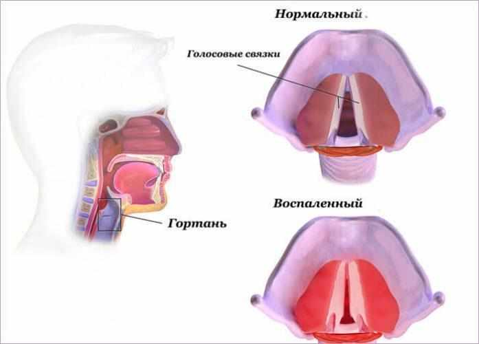 Утолщение стенок голосовых связок