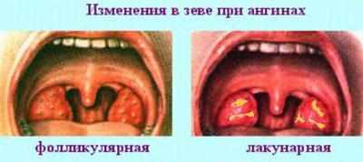 Виды ангины