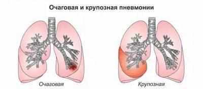 Отличие крупозной пневмонии