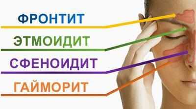 Виды синуситов
