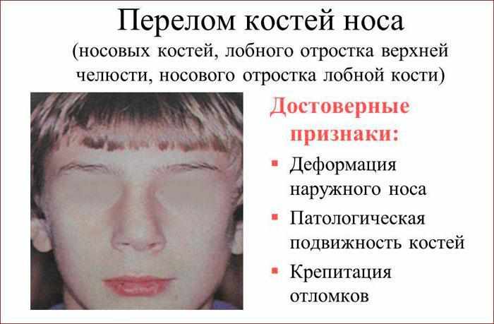 Признаки перелома носа