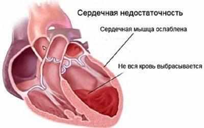 Сердечная недостаточность