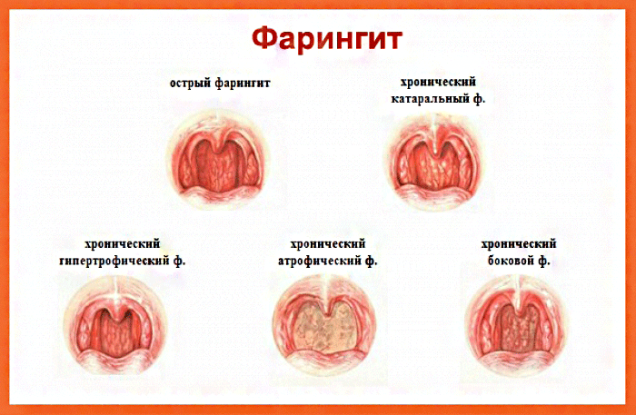 признаки фарингита