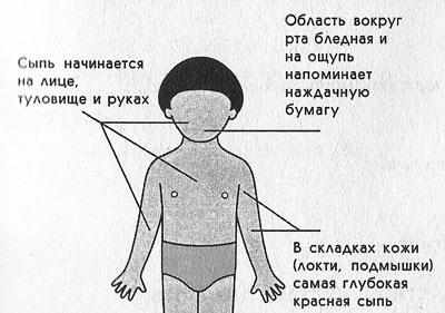 Сыпь при скарлатине