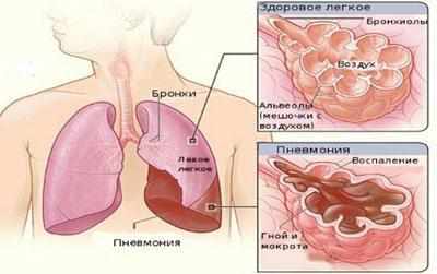 Воспаление лёгких