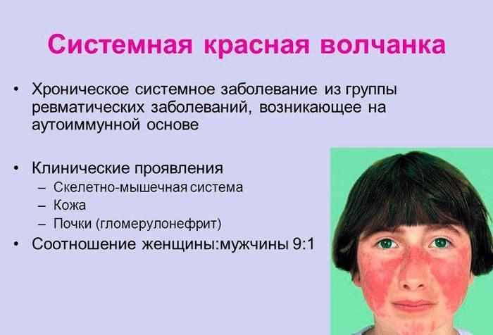 Системная красная волчанка