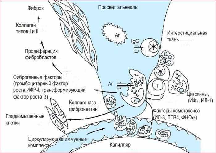 Идиопатический фиброзирующий альвеолит