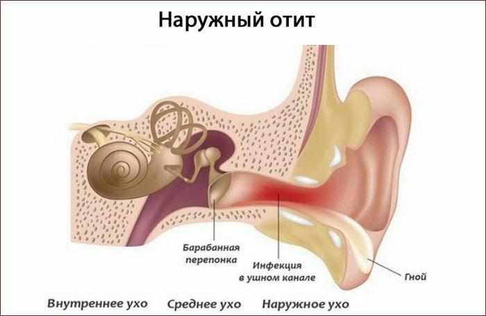 Симптомы наружного отита