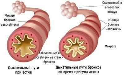 Бронхиальная астма