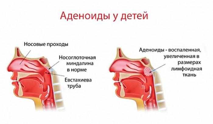 Аденоидит у детей