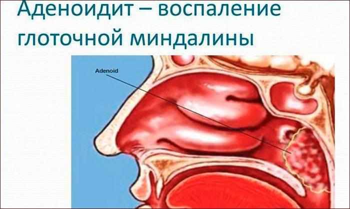 Аденоидит